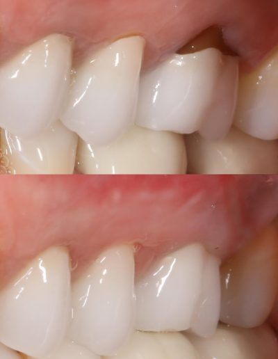 gum graft before and after